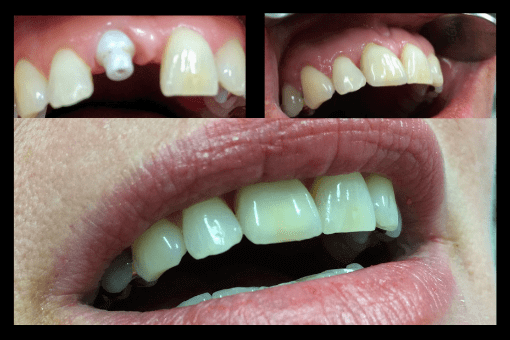 Keramik-Implantat Vorher Nachher - Zahnarzt Schwabach
